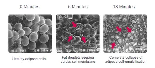Different stages of fat cells after laser therapy