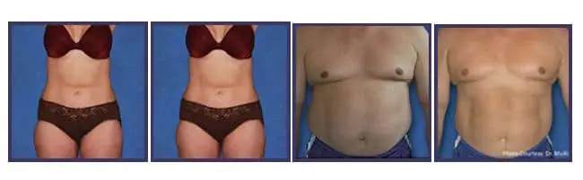 Results from laser weight loss